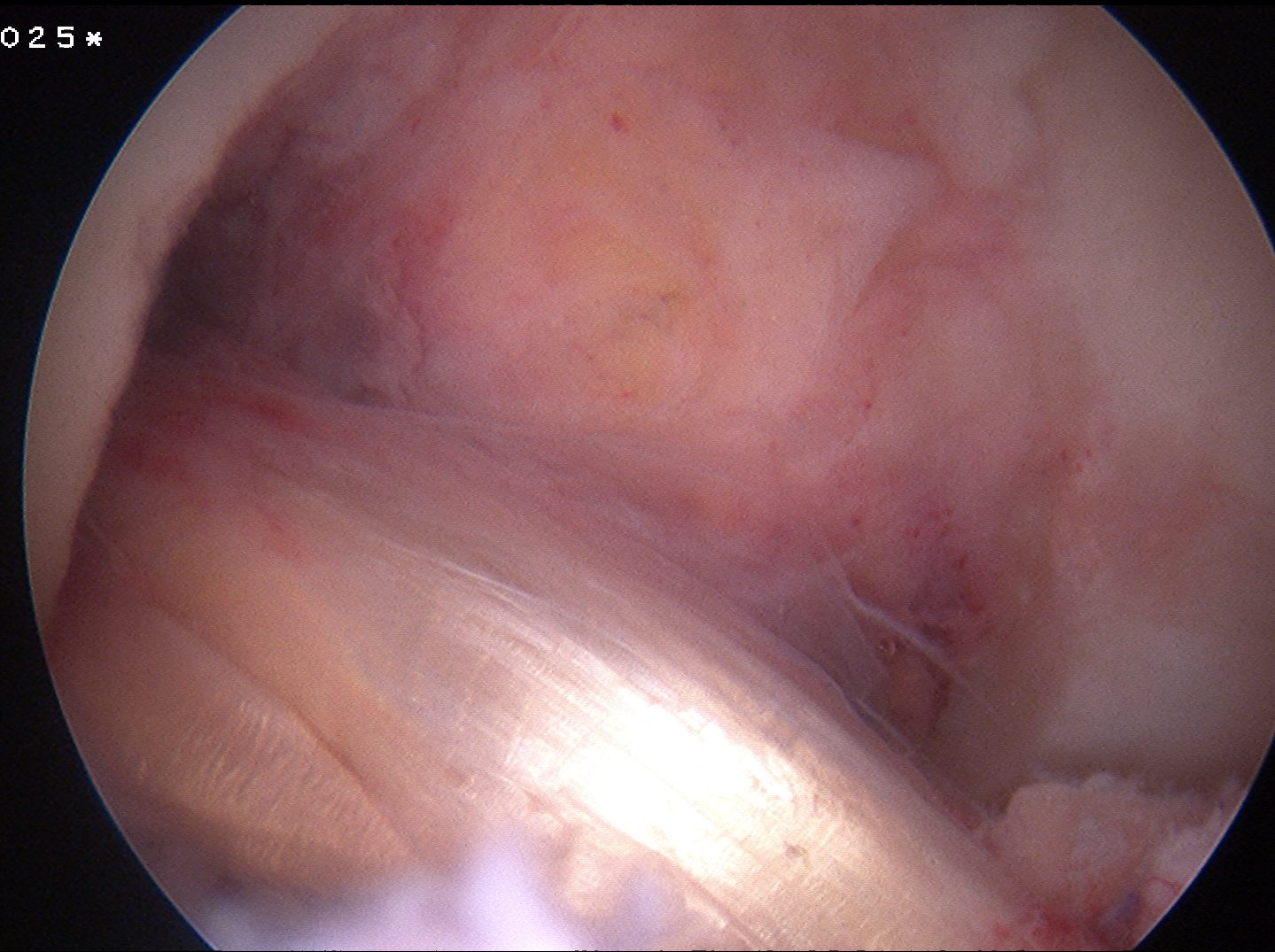 Revision ACL New Graft